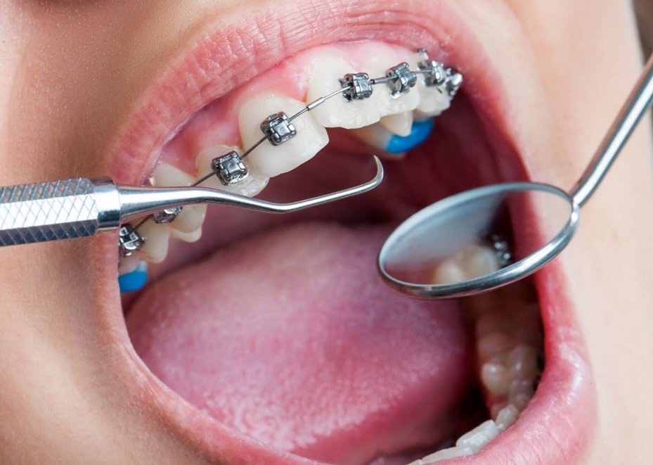 ارتودنسی پیشگیری برای دندانپزشکان عمومی